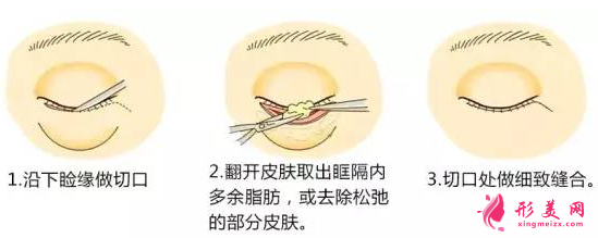 术后需要注意什么