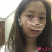 西安西京医院美容科隆鼻案例分享