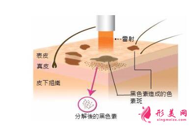 去除黄褐斑前需要注意的事项