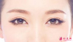 全切双眼皮需要多长时间恢复？