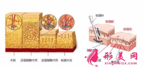 面部吸脂需要多少钱?