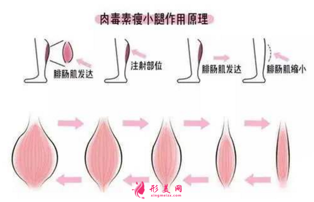 注射瘦腿针1个月，谈谈效果