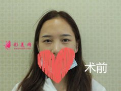 深圳赫思医疗美容怎么样？整形美容价目表及隆鼻整形案例