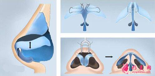 宽鼻缩窄示意图