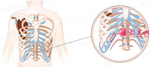 自体肋骨隆胸手术