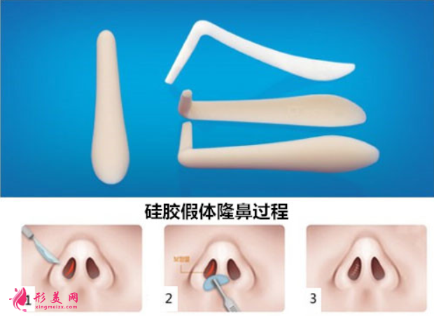 假体隆鼻效果可以保持多久