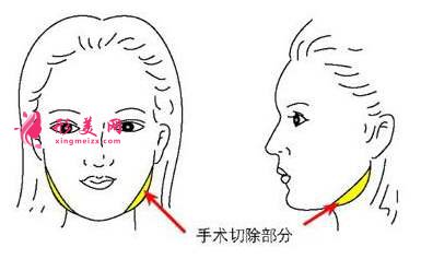 南宁下颌角切除真的可以让脸变小吗？