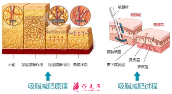 腰腹部吸脂后多久可以上班