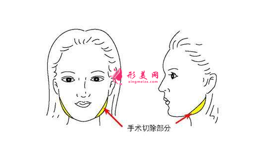 磨骨瘦脸手术多少钱