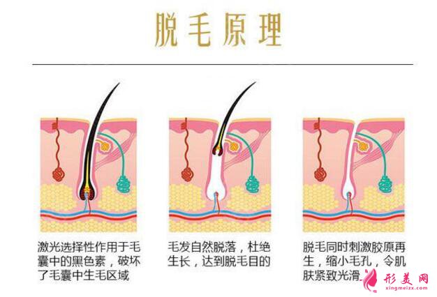 大腿永久脱毛多少钱