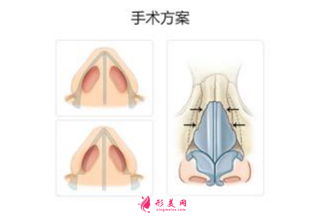 鼻骨缩小手术的难度