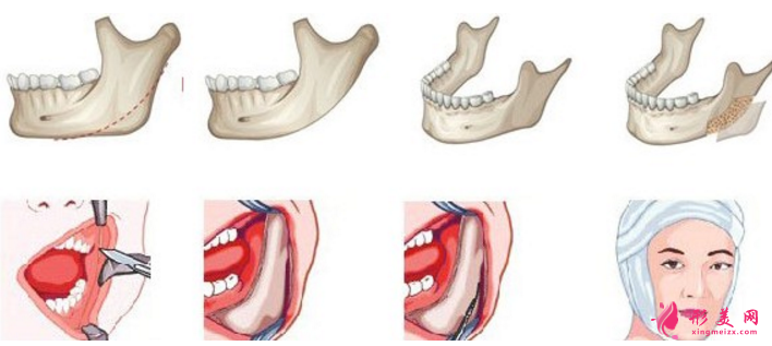 下颌角切除一般多少钱