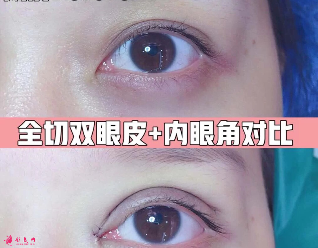 北京克莱美舍张冰洁眼综合案例