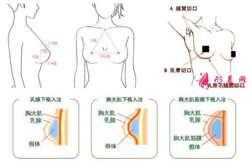 硅胶隆胸手术疼吗？疼痛时间维持多久？