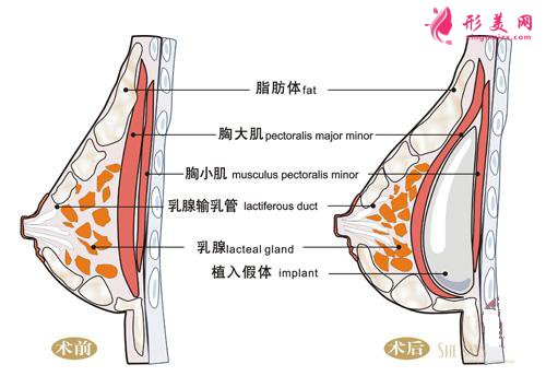 硅胶隆胸手术疼吗？疼痛时间维持多久？