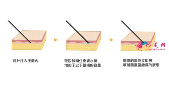 打玻尿酸要多少钱