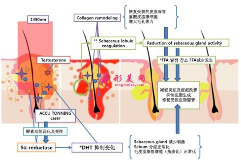 专家科普：怎么去除痘疤？价格是多少？