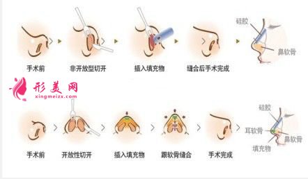 鼻翼整形的价格是多少？术后注意事项~