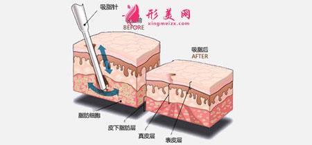 手臂吸脂术安全吗？吸脂一次多少钱？