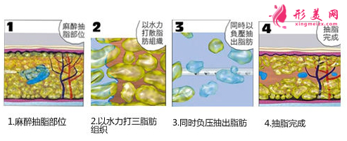 上臂吸脂后要穿多久塑身衣