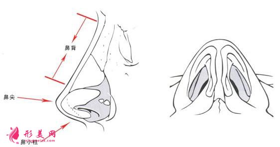 假体隆鼻的后遗症