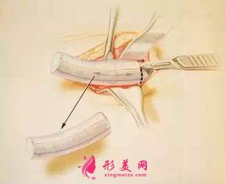 自体软骨隆鼻后会钙化吗