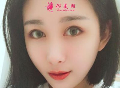 厦门华美医疗美容门诊部眼部多项案例