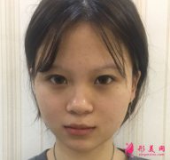 厦门安黛美医疗美容做双眼皮怎么样？真人案例分享