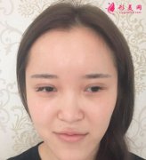 上海喜美王会勇鼻部修复怎么样？案例_价格分享给你们