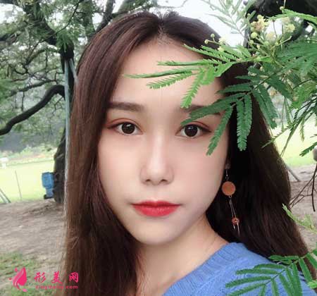 眼综合整形术后90天