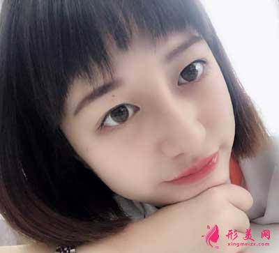 鼻综合整形术后18天