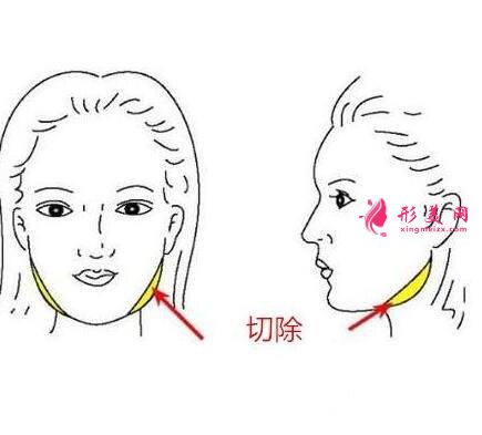 咬肌切除手术风险大么