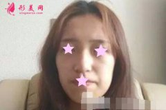 北京加减美整形怎么样？附面部脂肪填充案例恢复效果图