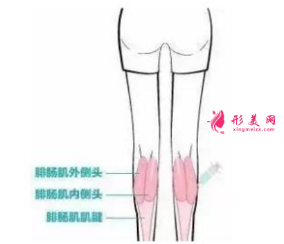 botox注射瘦小腿