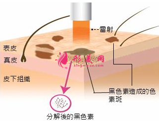 激光祛斑需要做多少次才有效果