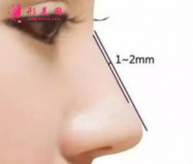 什么方法可以垫高鼻梁？