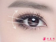 开眼角整形费用受哪些因素影响？