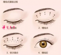 埋线双眼皮术后要怎样护理？