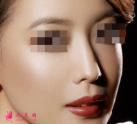 如何避免假体隆鼻的风险？