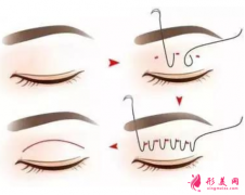 埋线双眼皮后脱线怎么办？
