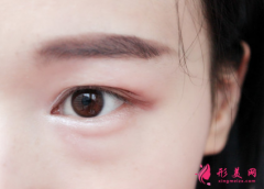 手术祛眼袋是怎么做的？