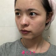 深圳富华医疗美容医院眼综合术后恢复案例分享