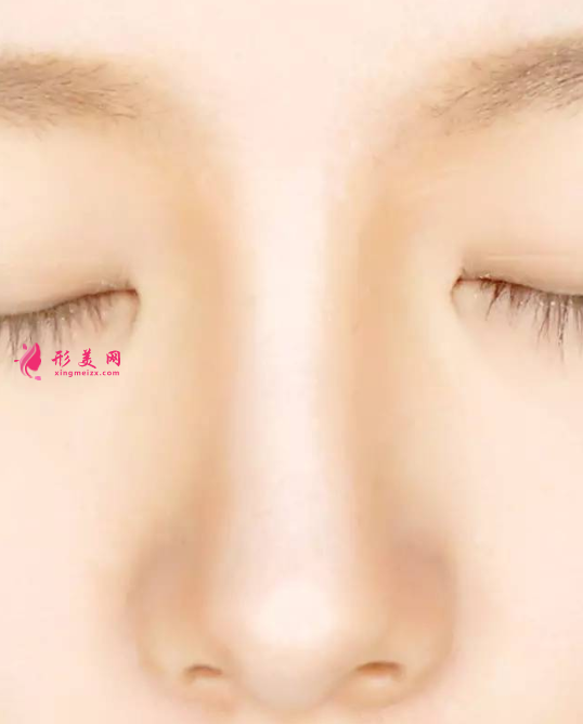 怎么样才能把鼻梁变高