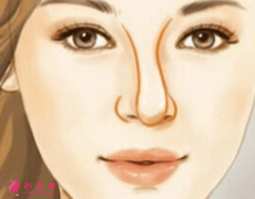 膨体隆鼻歪了怎么办？