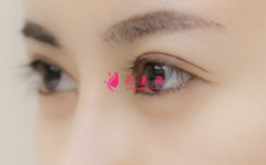 割双眼皮的手术费用是多少呢？