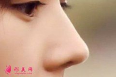 软骨隆鼻的效果多久稳定下来？