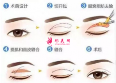 切双眼皮一般需要多少钱？