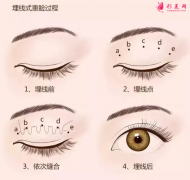 埋线双眼皮一般多久恢复正常？