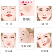 激光祛斑恢复期如何护理?