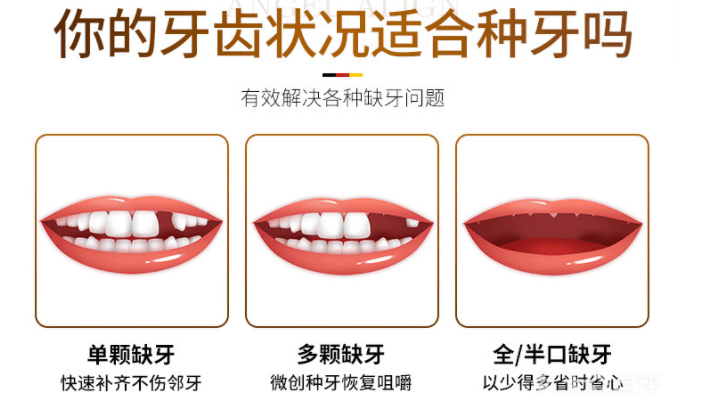 你的牙齿状况适合种牙吗